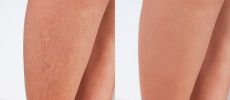 NUE IPL FDA Cleared Home Hair Removal Device offers Pain Free and Permanent Hair Removal Anywhere Hair Grows
